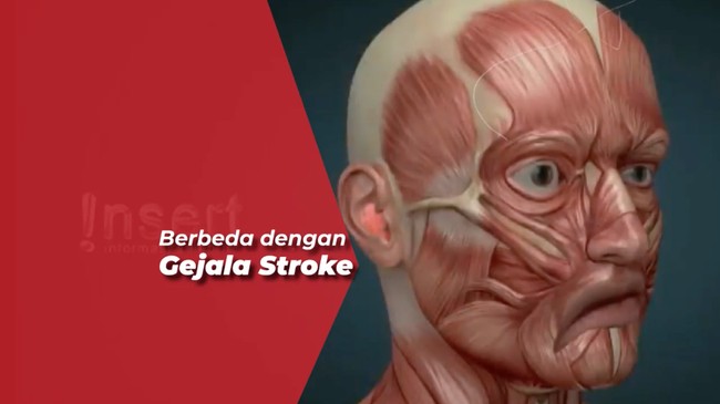 Lumpuh Sebagian Wajah, Apa Perbedaan Ramsay Hunt Syndrome dan Bell's Palsy?