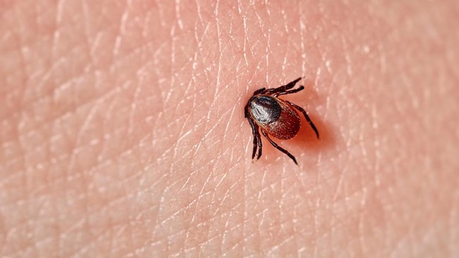 Sucking tick Macro photo on human skin. Ixodes ricinus. Bloated parasite bitten into pink irritated epidermis. Small red drops. Dangerous insect mite. Encephalitis, Lyme disease infection.
