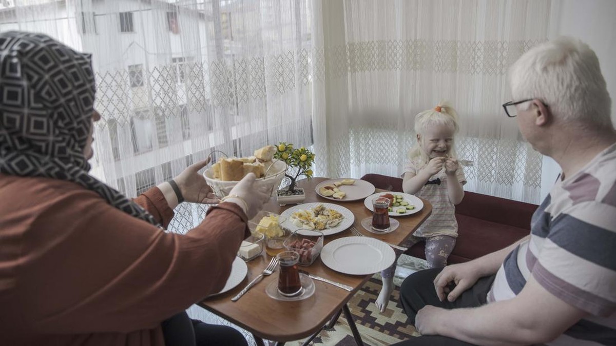 FOTO: Kisah Pasangan Albino di Turki Bersama-sama Lawan Stigma