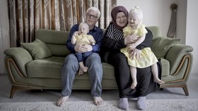 FOTO: Kisah Pasangan Albino di Turki Bersama-sama Lawan Stigma