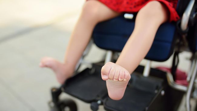 Manfaat ganja medis untuk kesehatan kembali diperbincangkan. Salah satunya untuk kondisi cerebral palsy. Apa itu cerebral palsy?