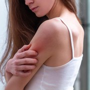 Cara Mengatasi Bekas Cacar Menggunakan Bahan Alami