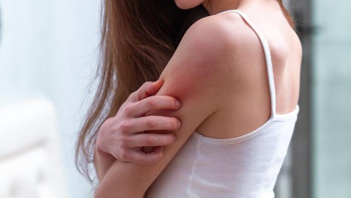 Cara Mengatasi Bekas Cacar Menggunakan Bahan Alami