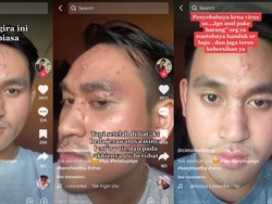 Fakta-fakta Herpes Zoster, Dikeluhkan Pria Jakarta Usai Disangka Jerawat