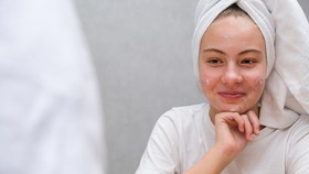 5 Cara Mencegah Jerawat pada Masa Pubertas