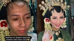 img-title 7 Potret Transformasi Makeup Pengantin dengan Bekas Cacar Viral