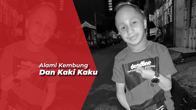 Dicky Topan 'Si Entong' Meninggal Dunia Akibat Pembengkakan Jantung