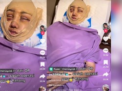 Lucinta Luna Belum Bisa Banyak Bicara, Mohon Doa Operasi Tahap Terakhir