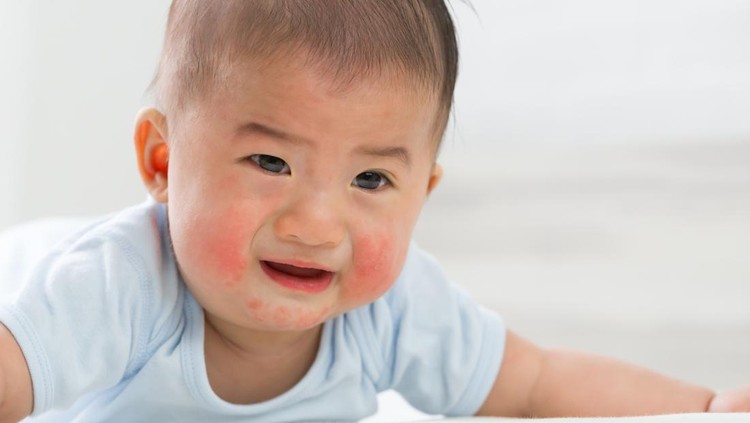 Bayi dengan Dermatitis Atopik