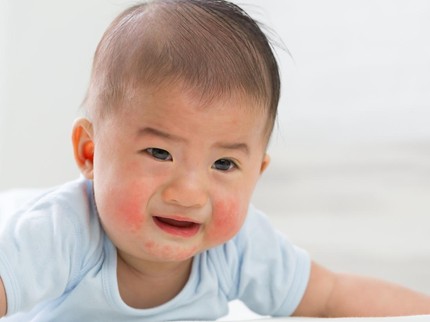 Dermatitis Atopik pada Bayi, Kenali Penyebab hingga Perawatan yang Dianjurkan Dokter