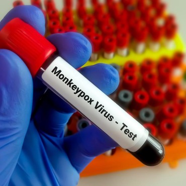 Cacar Monyet Bisa Menyerang Anak-anak? Ini Faktanya