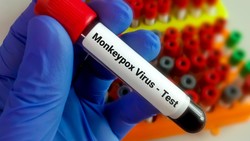 Cacar Monyet Bisa Menyerang Anak-anak? Ini Faktanya