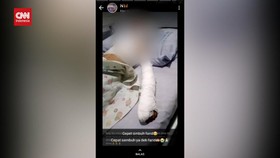 VIDEO: Bocah Alami Luka Bakar Akibat Jajanan Viral Ice Smoke