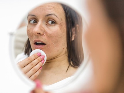 5 Tahapan Skincare untuk Menghilangkan Flek Hitam, Ketahui Dulu Penyebabnya
