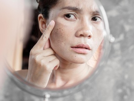 10 Cara Menghilangkan Bintik Hitam di Wajah seperti Tahi Lalat, dari Alami hingga Medis