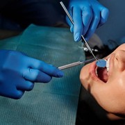 Selain Picu Rasa Nyeri, Ini 4 Alasan Mengapa Gigi Bungsu Harus Dicabut!