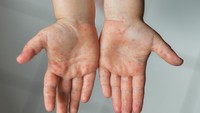 Apakah Anak Bayi yang Terkena Campak Boleh Mandi? Ini Kata Dokter
