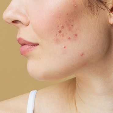 Minum Jus Wortel & Tomat Ampuh Hilangkan Jerawat, Mitos atau Fakta?