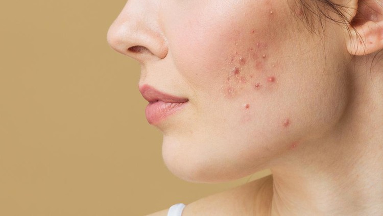 Young woman before and after acne treatment. Skin care concept