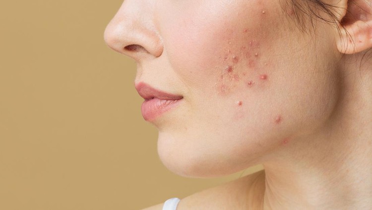 Ilustrasi Penyebab Jerawat Young woman before and after acne treatment. Skin care concept