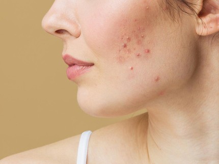 Mengenal Acne Prone Skin, Kondisi Wajah Rentan Berjerawat dan Cara Merawat yang Tepat