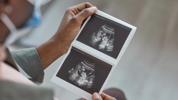 DIAGNOSIS KEHAMILAN KOSONG