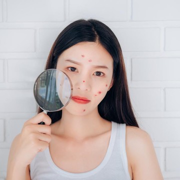 img-title Hati-hati, Stres Bisa Picu Datangnya Jerawat! Simak Penjelasan Dokter untuk Cek Cara Atasi yang Tepat