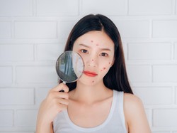 15 Cara Menghilangkan Bekas Jerawat yang Menghitam dan Aman