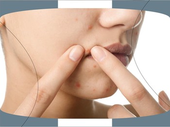 Hormonal Acne: Bagaimana Bisa Terjadi dan Cara Mengatasinya