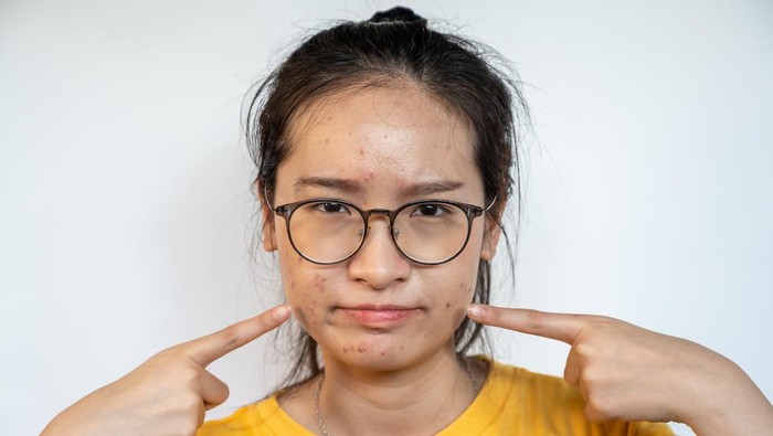 Alasan Kenapa Stres Bisa Pengaruhi Kesehatan dan Kecantikan Kulit, Berikut Penjelasannya Alasan Kenapa Stres Bisa Pengaruhi Kesehatan dan Kecantikan Kulit, Berikut Penjelasannya