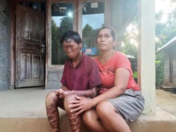 Kisah Malang Remaja Bontihing Buleleng Idap Penyakit Kulit Bersisik