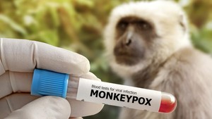 Cacar Monyet di AS Ditemukan 99 Persen Serang Laki-laki