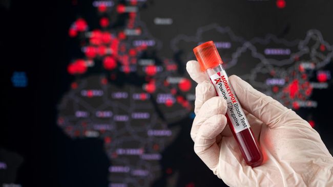 Le ministère de la Santé confirme que les patients suspects de Lamongan sont négatifs pour le monkeypox