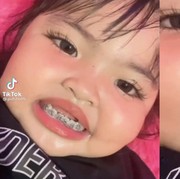 Balita Dipasangi Behel oleh Ibunya dan Viral di TikTok, Menurut Dokter Ini Deretan Bahayanya!