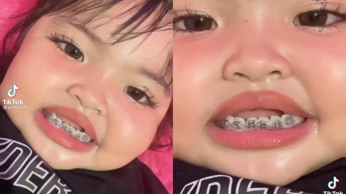 Balita Dipasangi Behel oleh Ibunya dan Viral di TikTok, Menurut Dokter Ini Deretan Bahayanya!