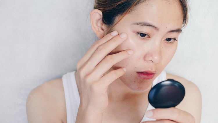 Conceptual shot of Acne & Problem Skin on female face.