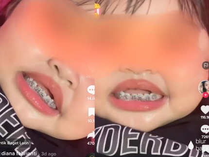 Viral Balita Pakai Behel Tuai Kritikan, Usia Berapa Anak Boleh Pasang Kawat Gigi?