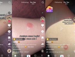 Viral Wanita Kena Ruam Seluruh Tubuh, Dikira Digigit Serangga Ternyata Kena...