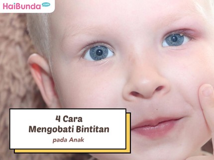 4 Cara Mengobati Bintitan pada Anak