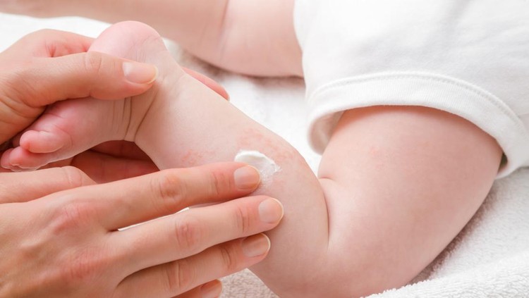 ruam kulit Penyebab dan cara mengobati ruam kulit anak.