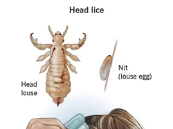 6 Tips Menghilangkan Kutu Rambut dengan Mudah dan Cepat