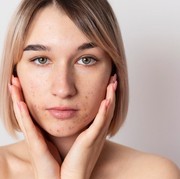 3 Cara Mudah Mencegah Jerawat Membekas Jadi Noda Hitam atau Kemerahan