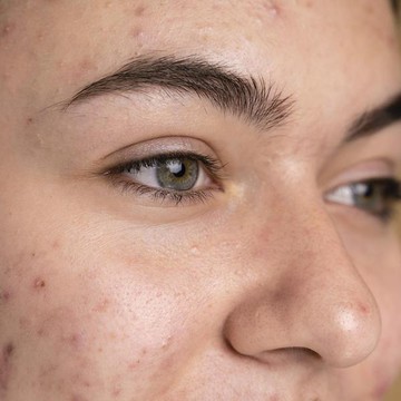 img-title Cara Hilangkan Flek Hitam di Wajah, Benar Bisa Pakai Sunscreen?