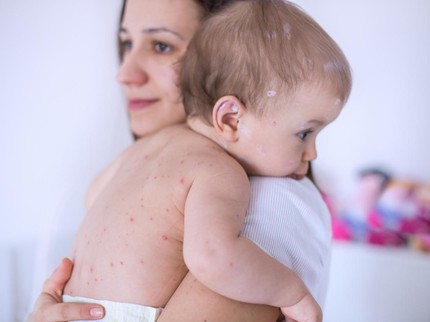 9 Cara Mengatasi Biang Keringat pada Bayi Sesuai Jenisnya