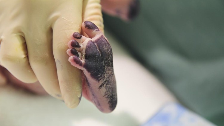 newborn baby foot close-up right after taking footprints during delivery