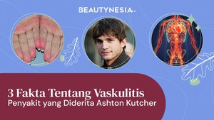 3 Fakta Tentang Vaskulitis, Penyakit yang Diderita Ashton Kutcher