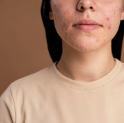 4 Fakta Tentang Jerawat Hormonal dan Cara Mengatasinya