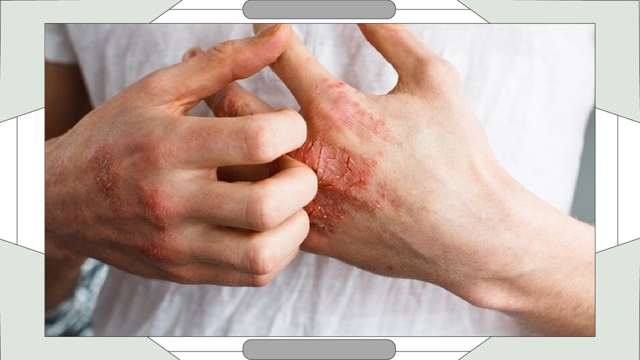 They Don't Talk About: Psoriasis