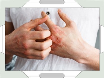 They Don't Talk About: Psoriasis