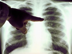 Ngeri! Dokter Paru Sebut Uap Vape Bisa Picu Kondisi Langka Popcorn Lung